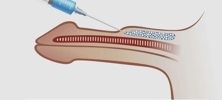 injekce do penisu